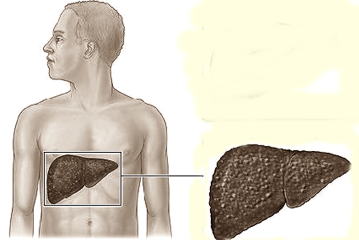 Signs and Symptoms of Liver Disease to Watch Out for