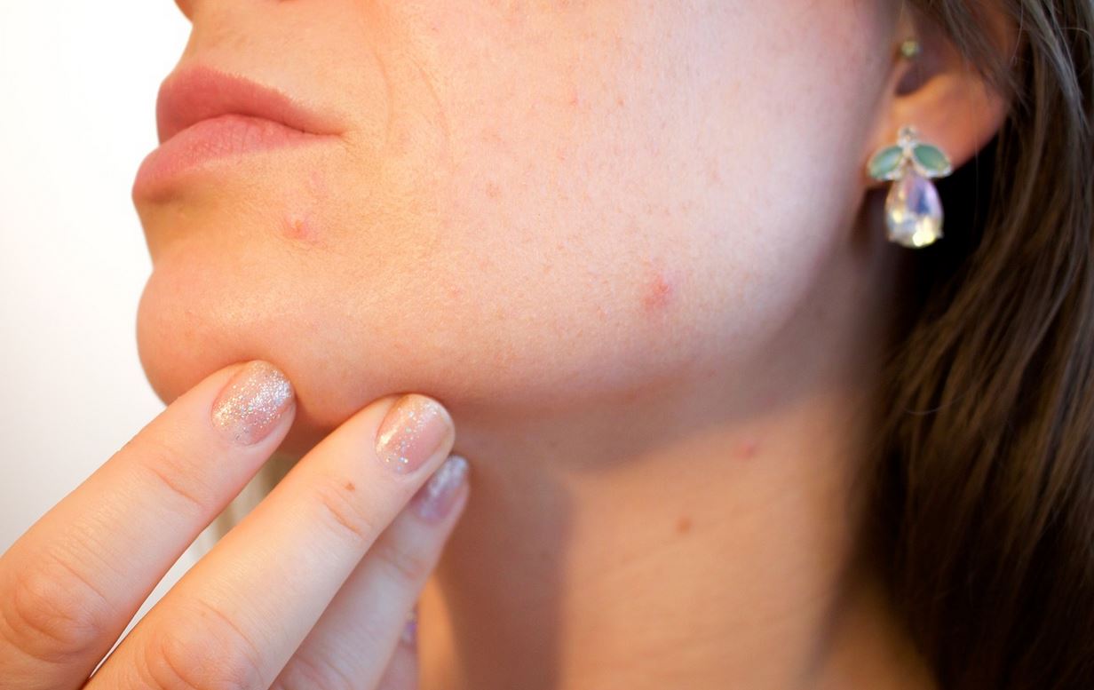 Chicken pox home remedies and some of the best hospitals in Kenya for treatment