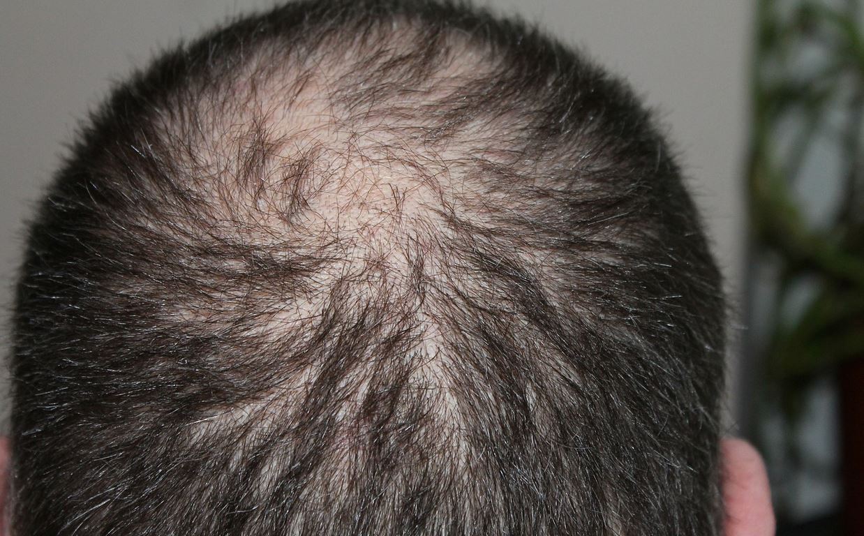Hair loss treatment in Kenya and where to buy hair growth products